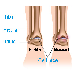 Zimmer® Trabecular Metal™ Total Ankle