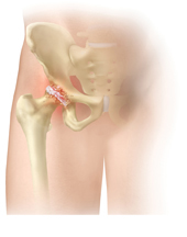 Hip Pain Overview