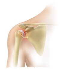 Shoulder Pain Overview
