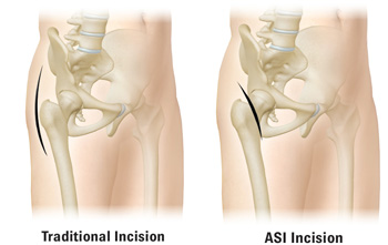 Hip Treatment Options