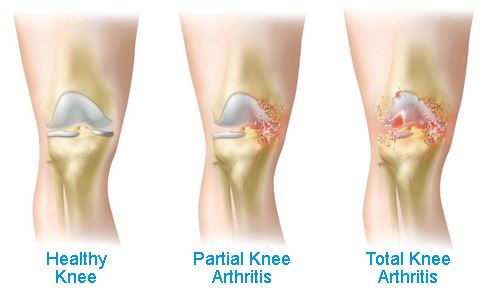 Knee Treatment Options