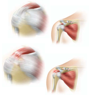 Comprehensive® Reverse Shoulder Replacement
